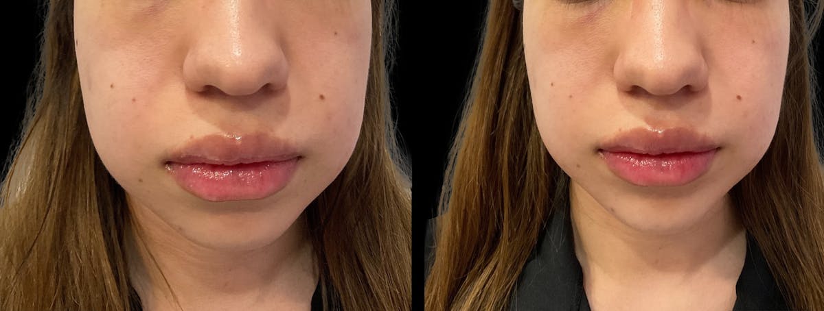 Dermal Filler Before & After Gallery - Patient 253733 - Image 1