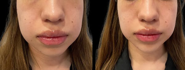 Dermal Filler Before & After Gallery - Patient 253733 - Image 1