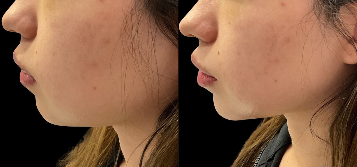 Dermal Filler Before & After Gallery - Patient 253733 - Image 2