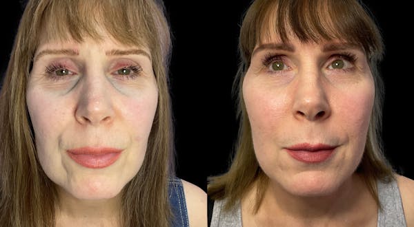 Dermal Filler Before & After Gallery - Patient 120710 - Image 1