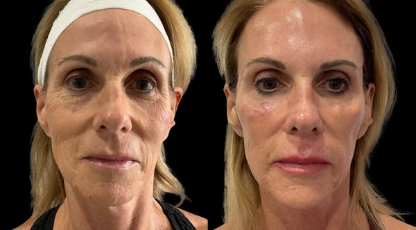 Dermal Filler Before & After Gallery - Patient 110234 - Image 1