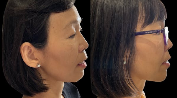 Dermal Filler Before & After Gallery - Patient 554881 - Image 1
