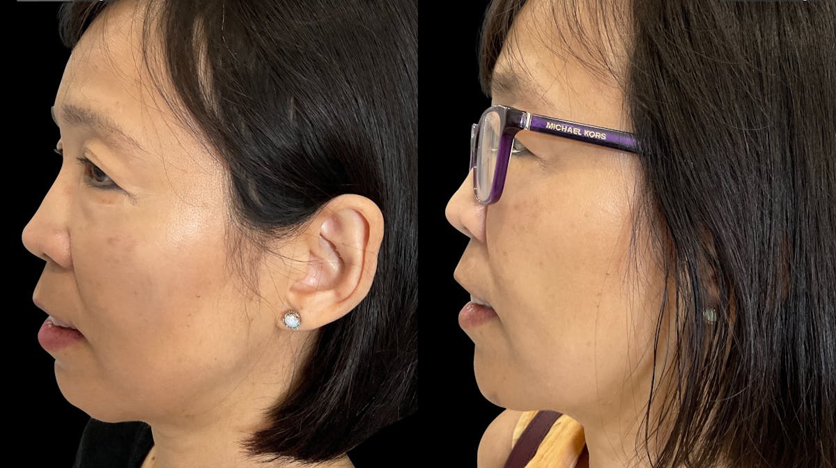 Dermal Filler Before & After Gallery - Patient 554881 - Image 2