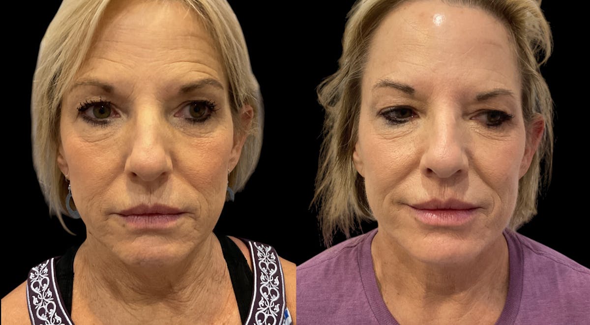 PDO Threads Before & After Gallery - Patient 299317 - Image 1