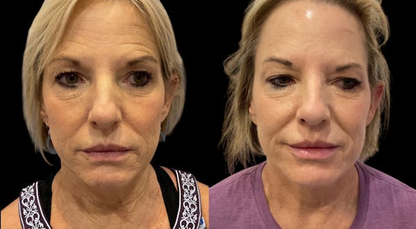 PDO Threads Before & After Gallery - Patient 299317 - Image 1