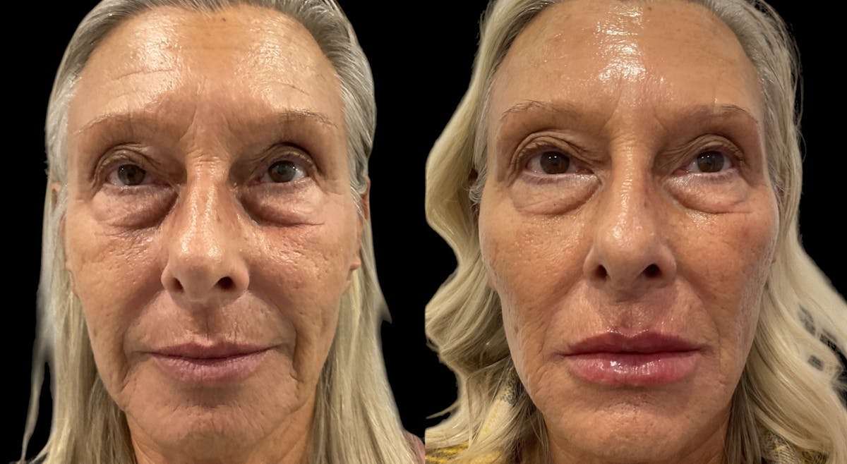 Dermal Filler Before & After Gallery - Patient 266524 - Image 3