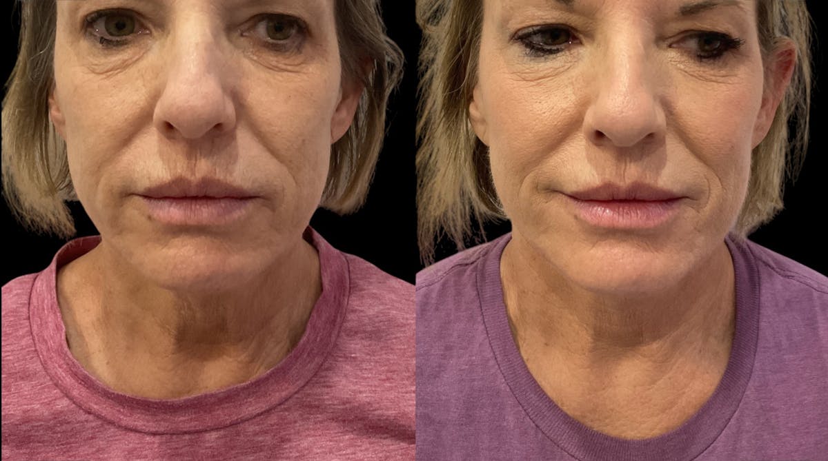 PDO Threads Before & After Gallery - Patient 299317 - Image 2