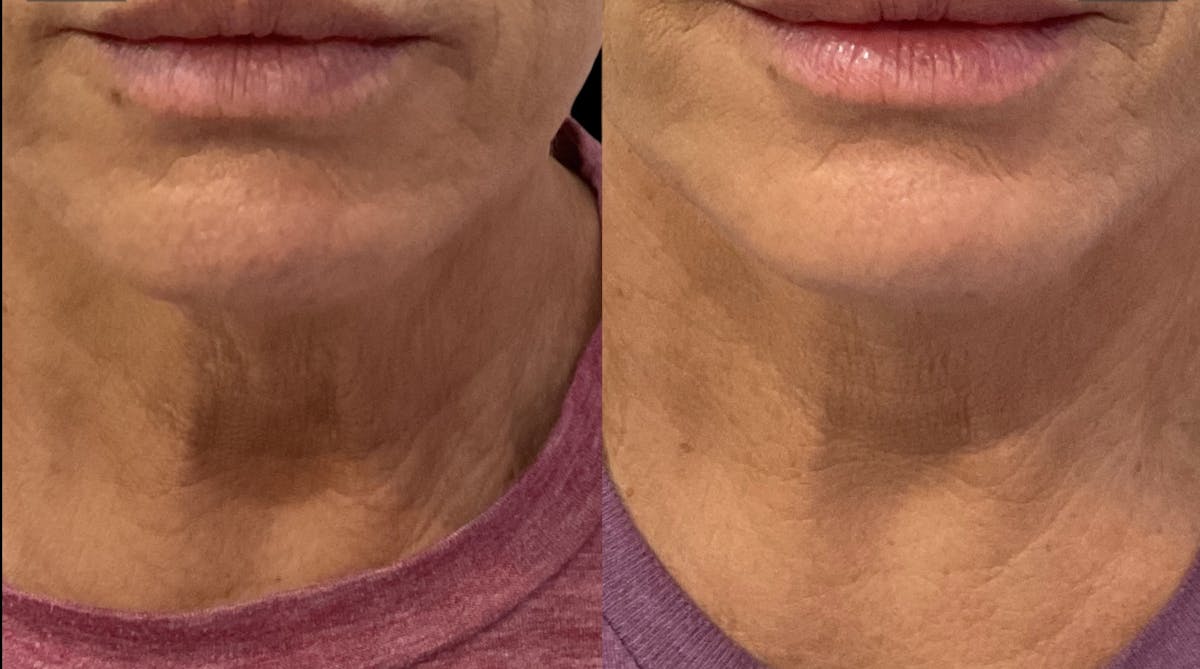 PDO Threads Before & After Gallery - Patient 299317 - Image 3