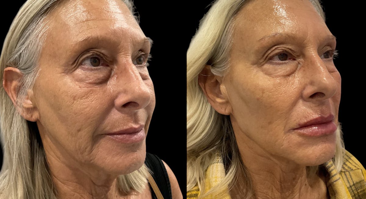 Dermal Filler Before & After Gallery - Patient 266524 - Image 1