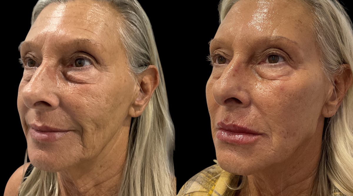 Dermal Filler Before & After Gallery - Patient 266524 - Image 4