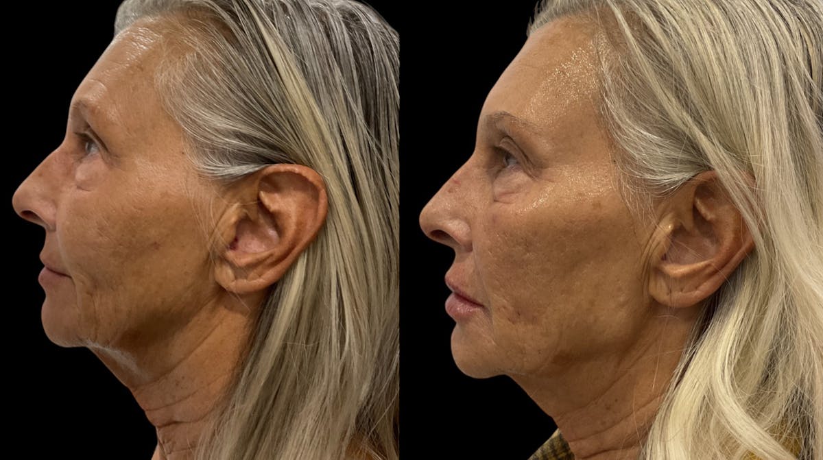 Dermal Filler Before & After Gallery - Patient 266524 - Image 5