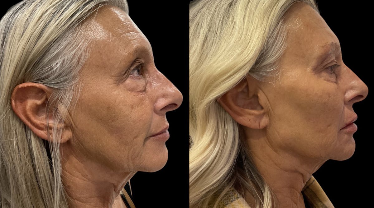 Dermal Filler Before & After Gallery - Patient 266524 - Image 2