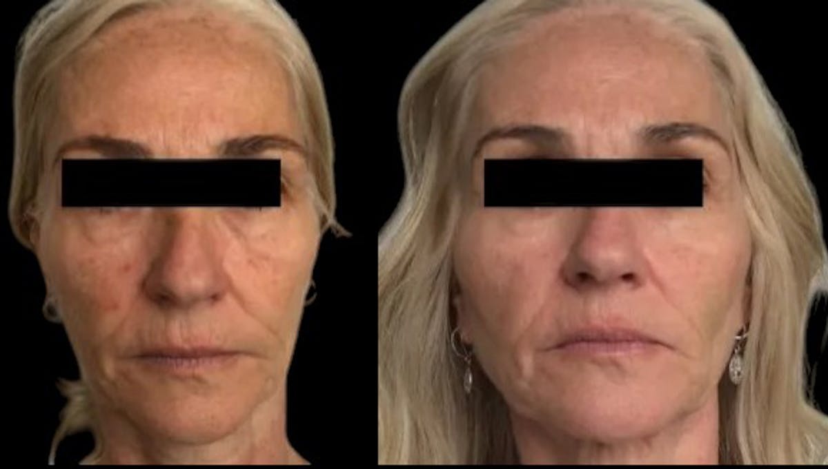 PDO Threads Before & After Gallery - Patient 293711 - Image 1