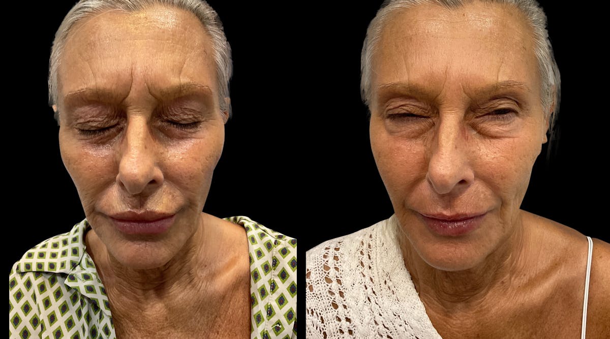 Neurotoxins Before & After Gallery - Patient 341181 - Image 1