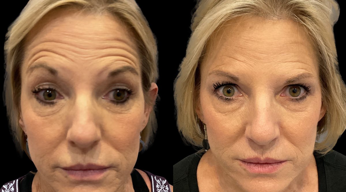Neurotoxins Before & After Gallery - Patient 121277 - Image 2