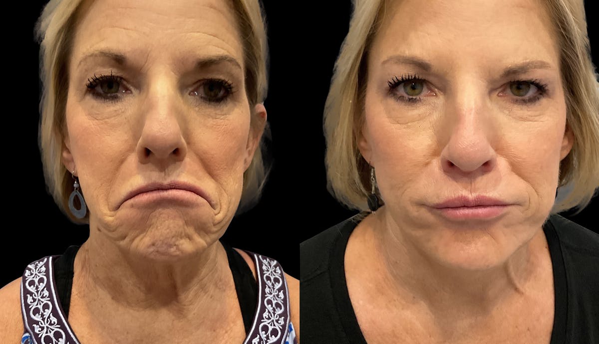 Neurotoxins Before & After Gallery - Patient 121277 - Image 3