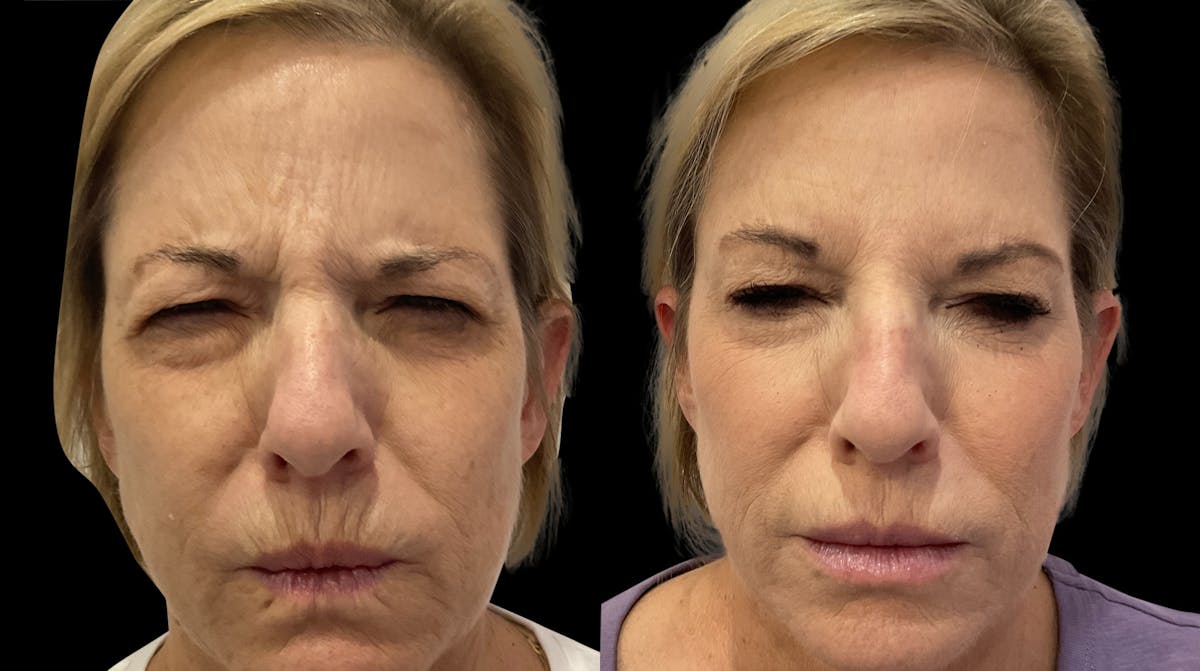 Neurotoxins Before & After Gallery - Patient 121277 - Image 4