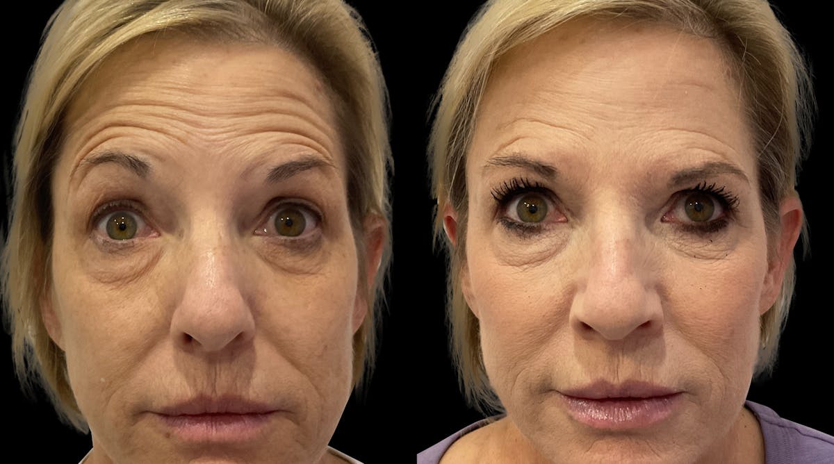 Neurotoxins Before & After Gallery - Patient 121277 - Image 5