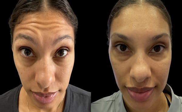 Neurotoxins Before & After Gallery - Patient 158842 - Image 1