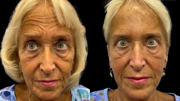 Neurotoxins Before & After Gallery - Patient 185345 - Image 1