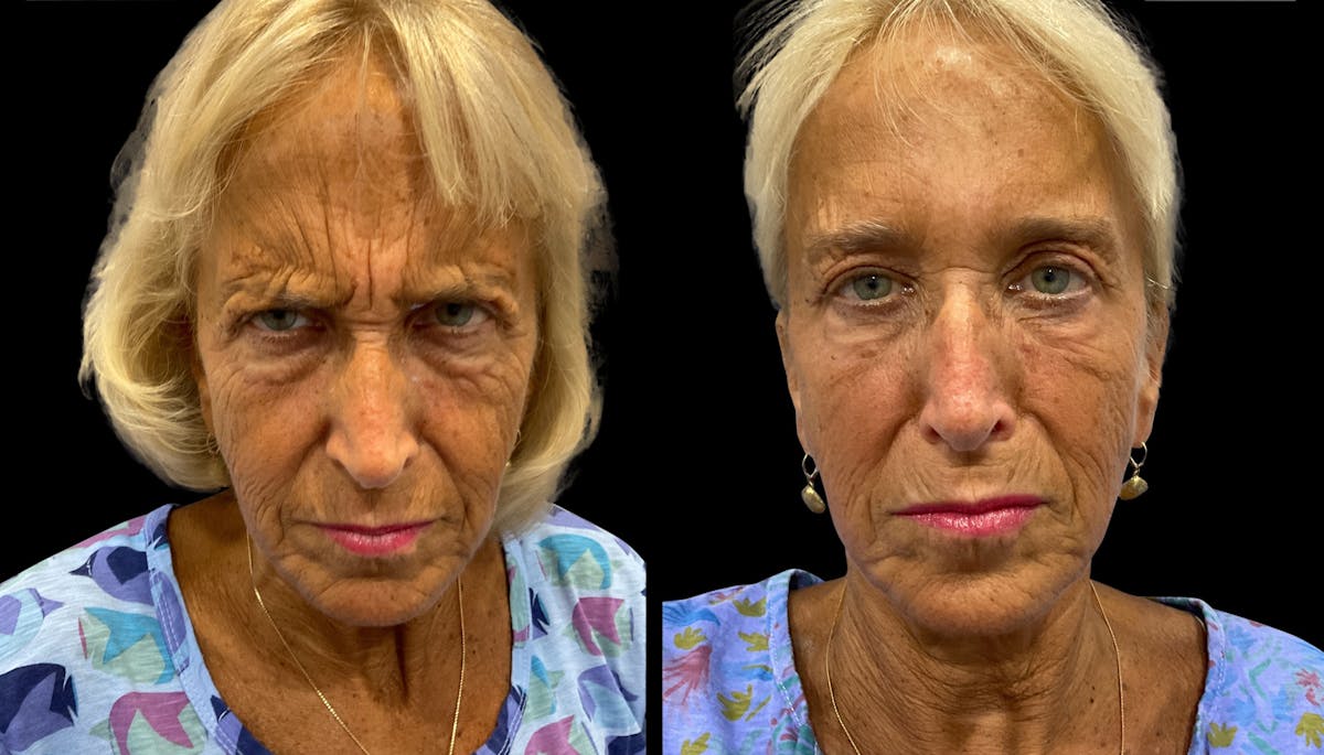 Neurotoxins Before & After Gallery - Patient 185345 - Image 2