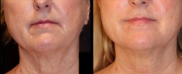 Exosomes Before & After Gallery - Patient 323781 - Image 1