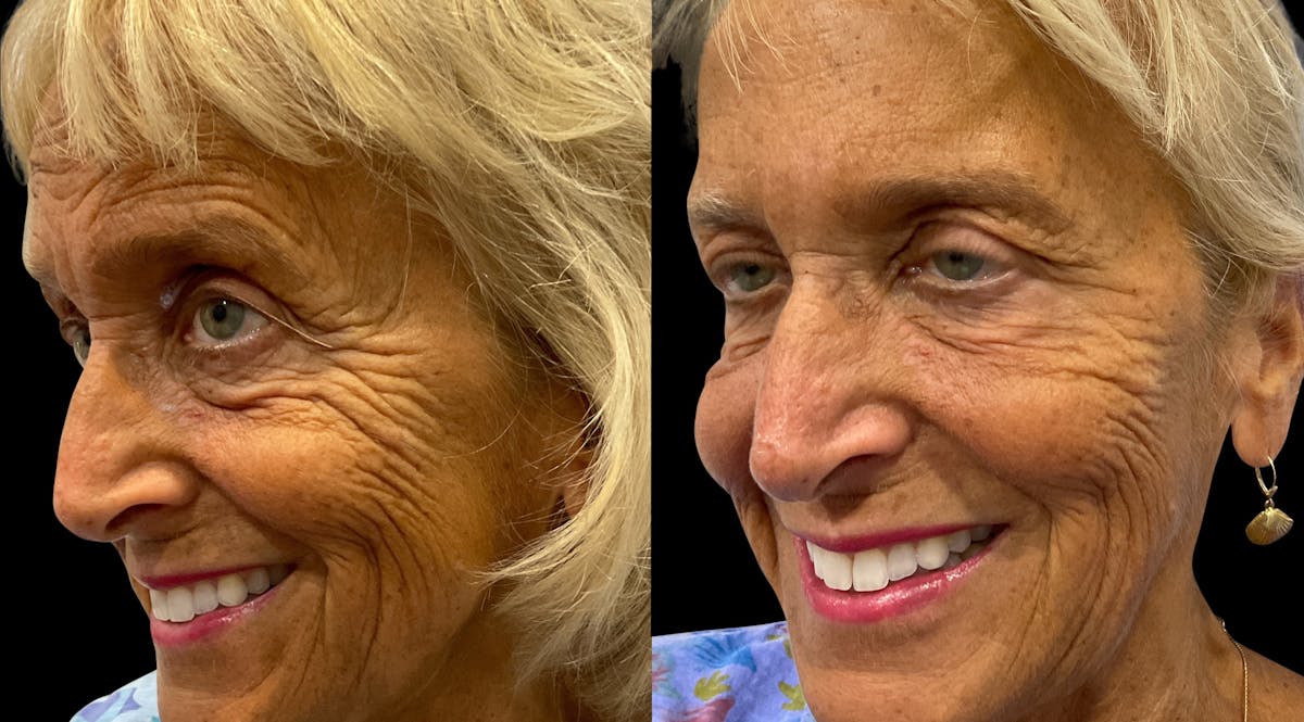 Neurotoxins Before & After Gallery - Patient 185345 - Image 3