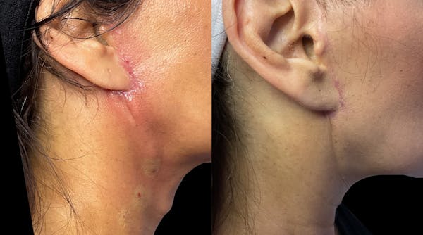 Exosomes Before & After Gallery - Patient 291731 - Image 1