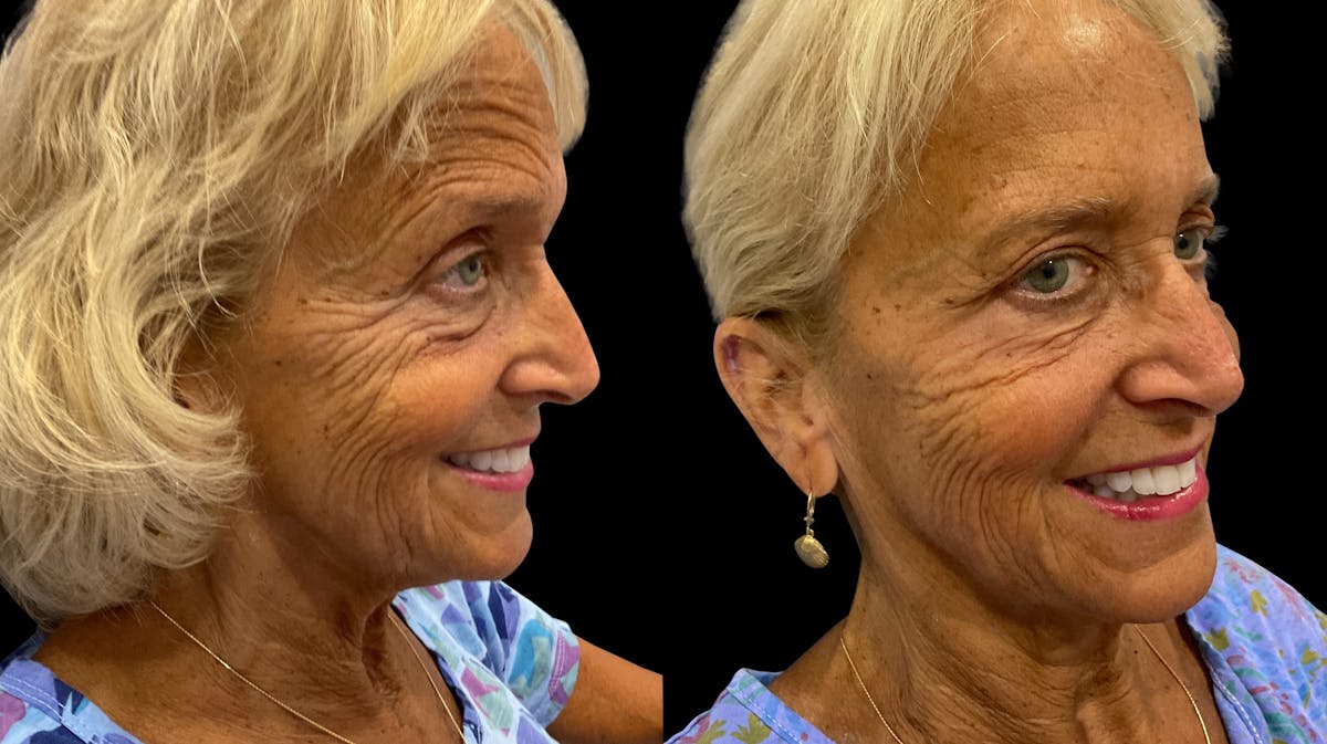 Neurotoxins Before & After Gallery - Patient 185345 - Image 4