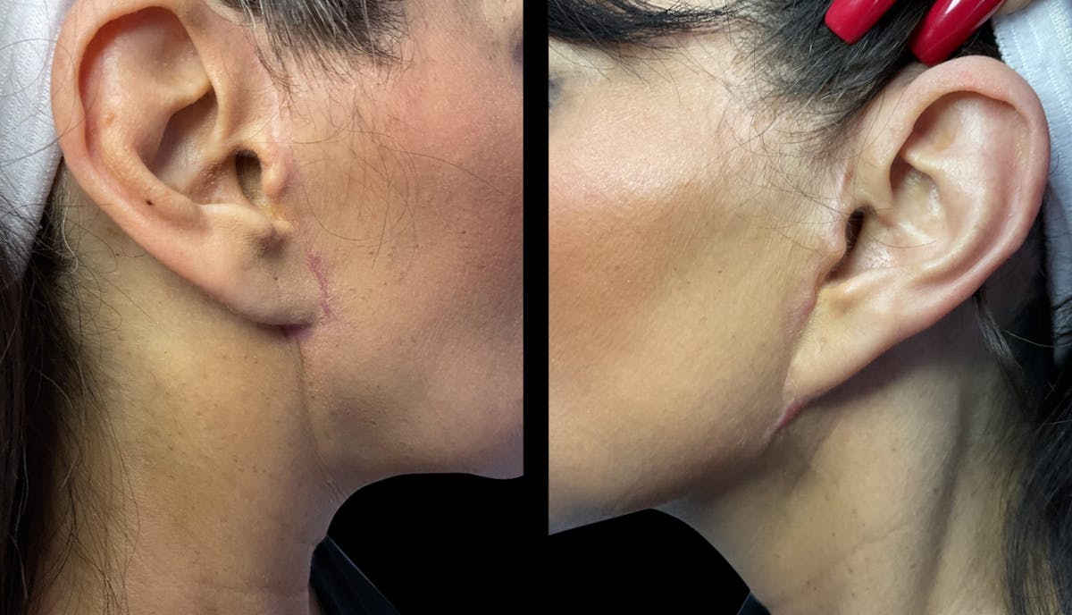 Exosomes Before & After Gallery - Patient 291731 - Image 3