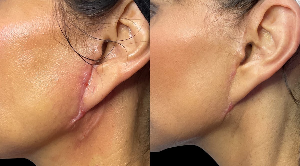 Exosomes Before & After Gallery - Patient 291731 - Image 2