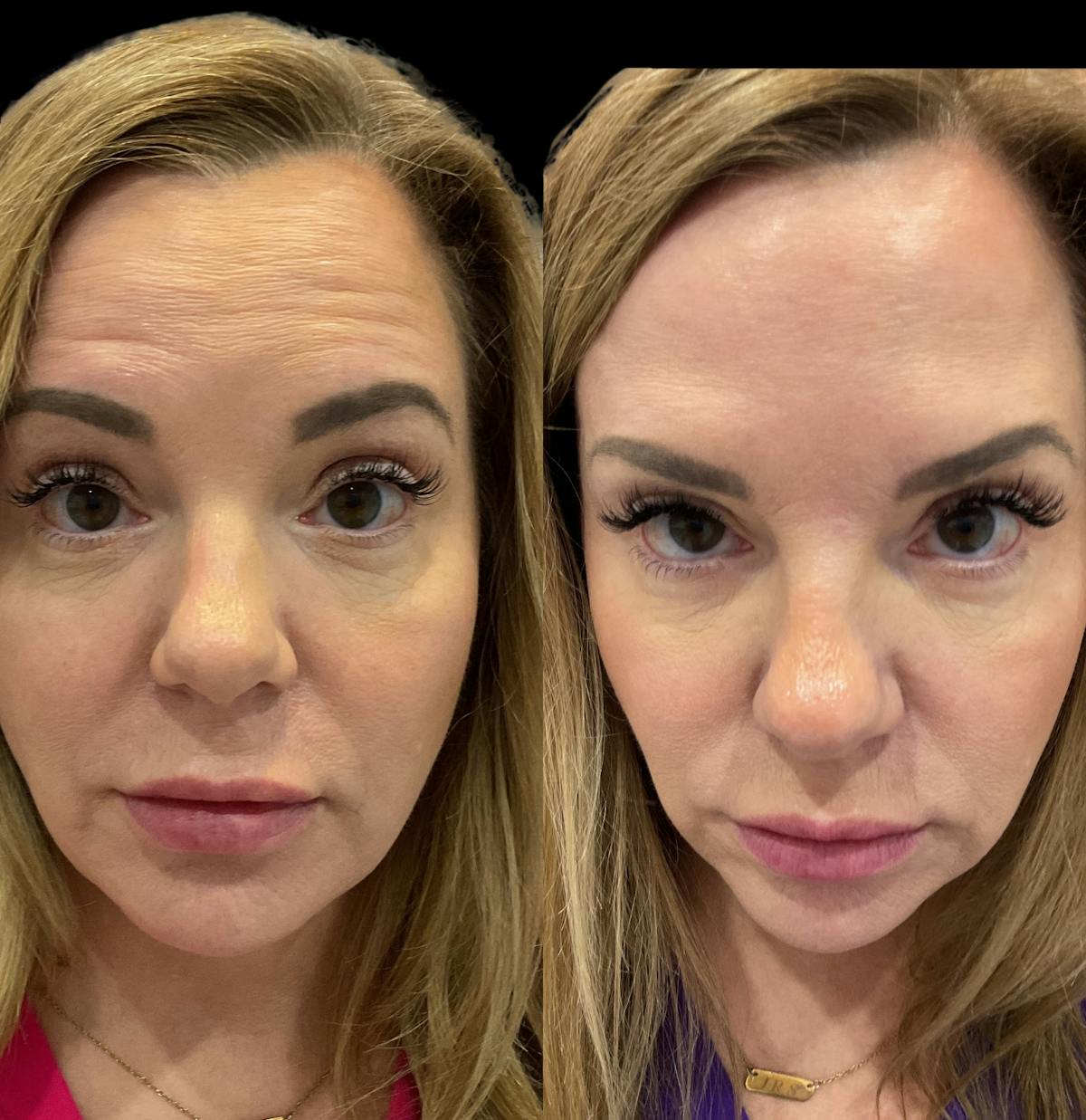 Neurotoxins Before & After Gallery - Patient 336693 - Image 4