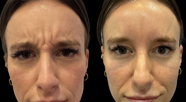 Neurotoxins Before & After Gallery - Patient 207313 - Image 1
