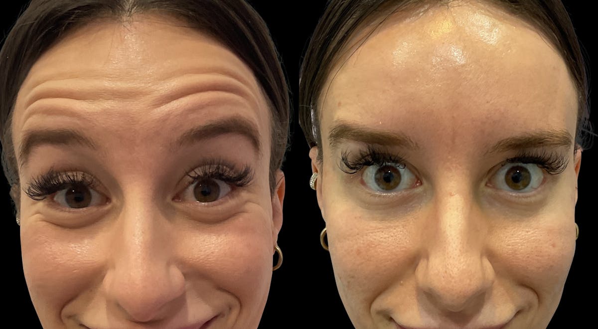 Neurotoxins Before & After Gallery - Patient 207313 - Image 2