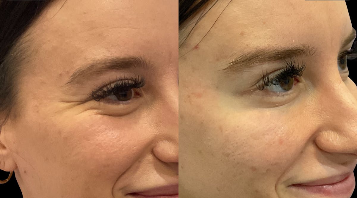 Neurotoxins Before & After Gallery - Patient 207313 - Image 3