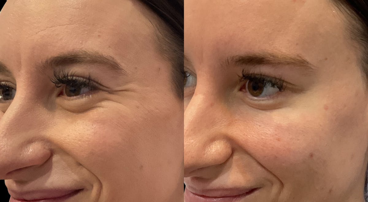 Neurotoxins Before & After Gallery - Patient 207313 - Image 4
