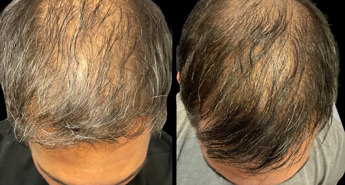 Exosomes Before & After Gallery - Patient 103046 - Image 2