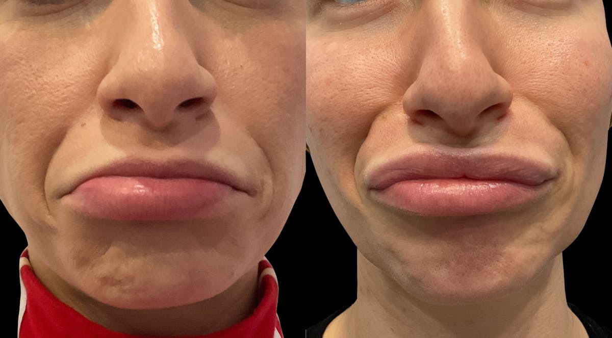 Neurotoxins Before & After Gallery - Patient 207313 - Image 5