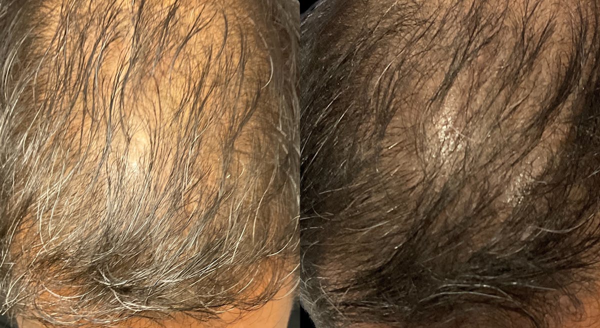 Exosomes Before & After Gallery - Patient 103046 - Image 3