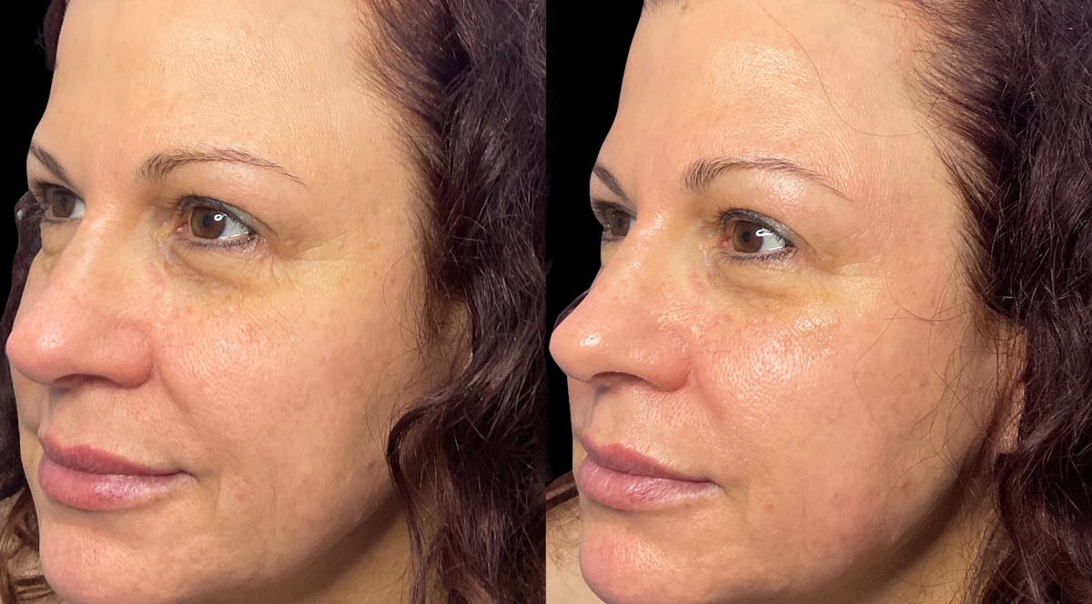 Geneo Before & After Gallery - Patient 160380 - Image 1