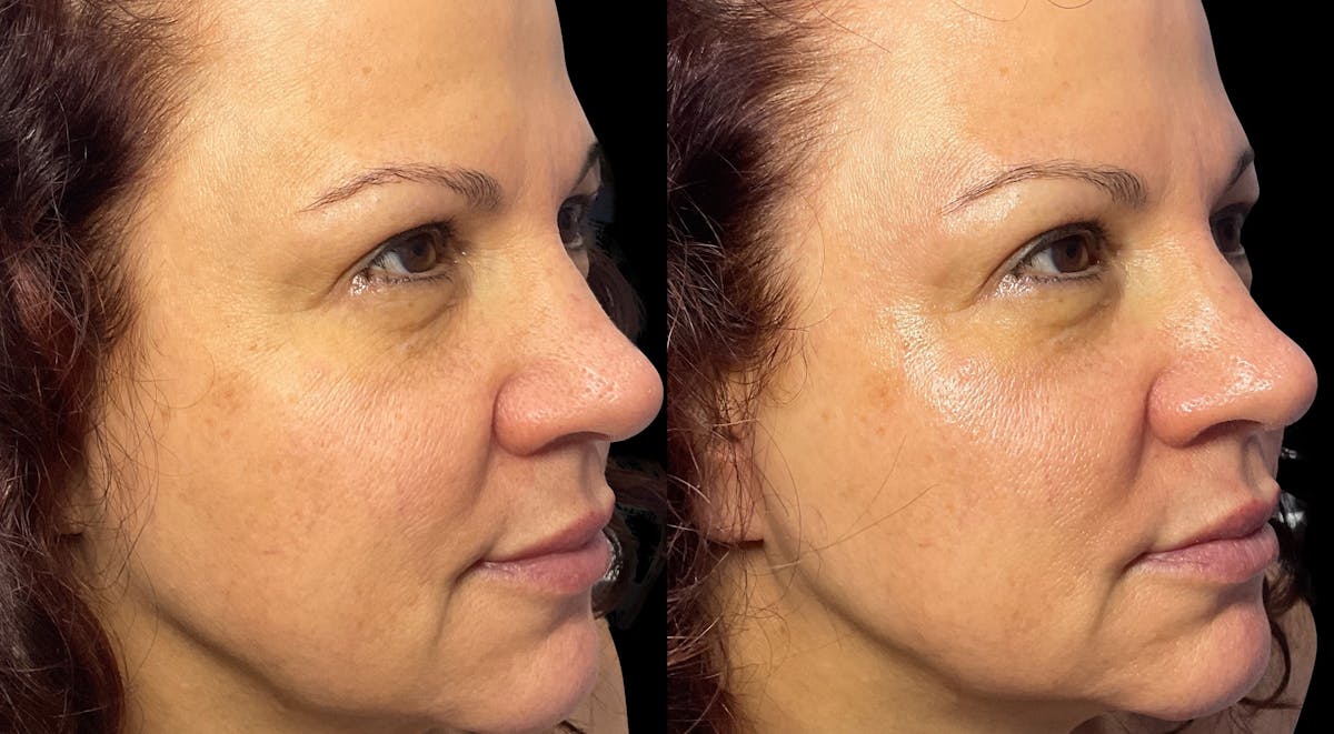 Geneo Before & After Gallery - Patient 160380 - Image 2