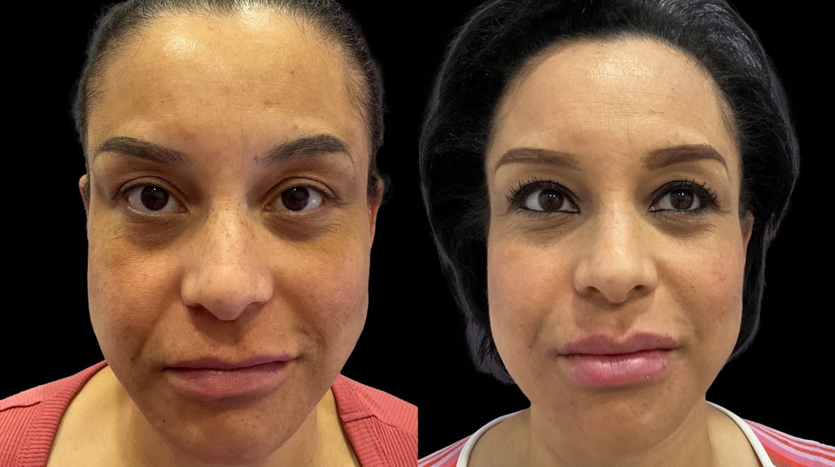 Medical Grade Facials Before & After Gallery - Patient 400859 - Image 1