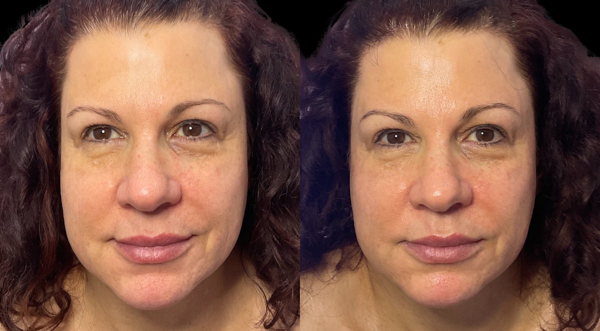 Geneo Before & After Gallery - Patient 160380 - Image 3