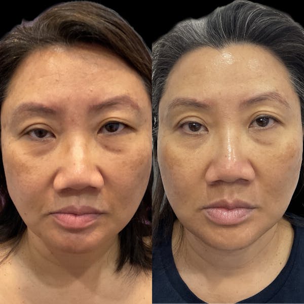 Medical Grade Facials Before & After Gallery - Patient 360655 - Image 1