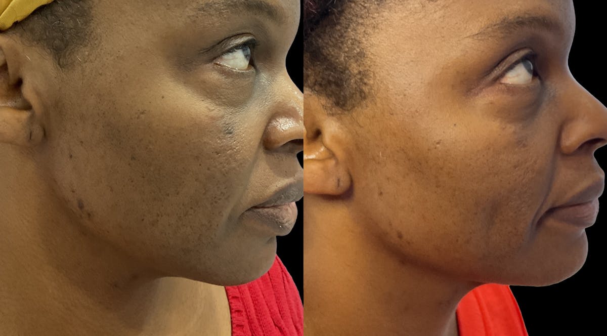 Medical Grade Facials Before & After Gallery - Patient 114674 - Image 3