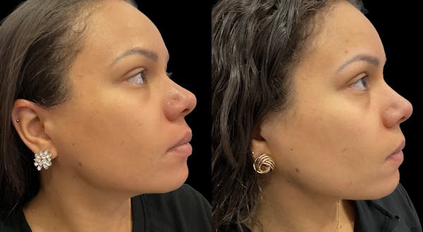 Hydrafacial Before & After Gallery - Patient 276302 - Image 1