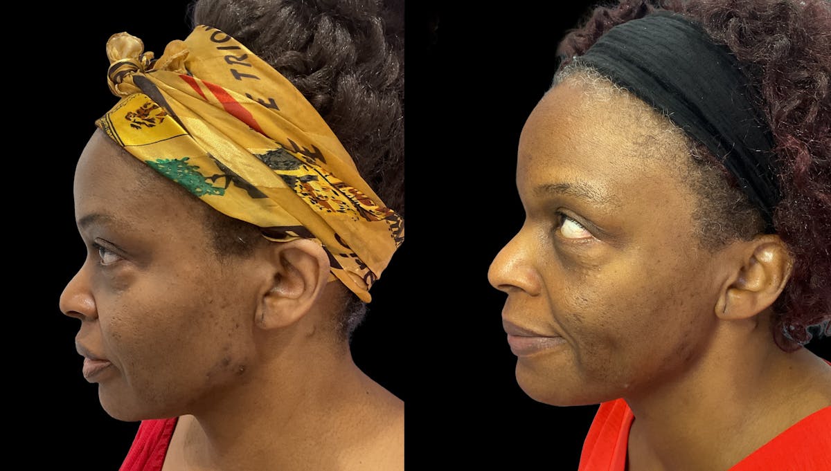Medical Grade Facials Before & After Gallery - Patient 114674 - Image 1