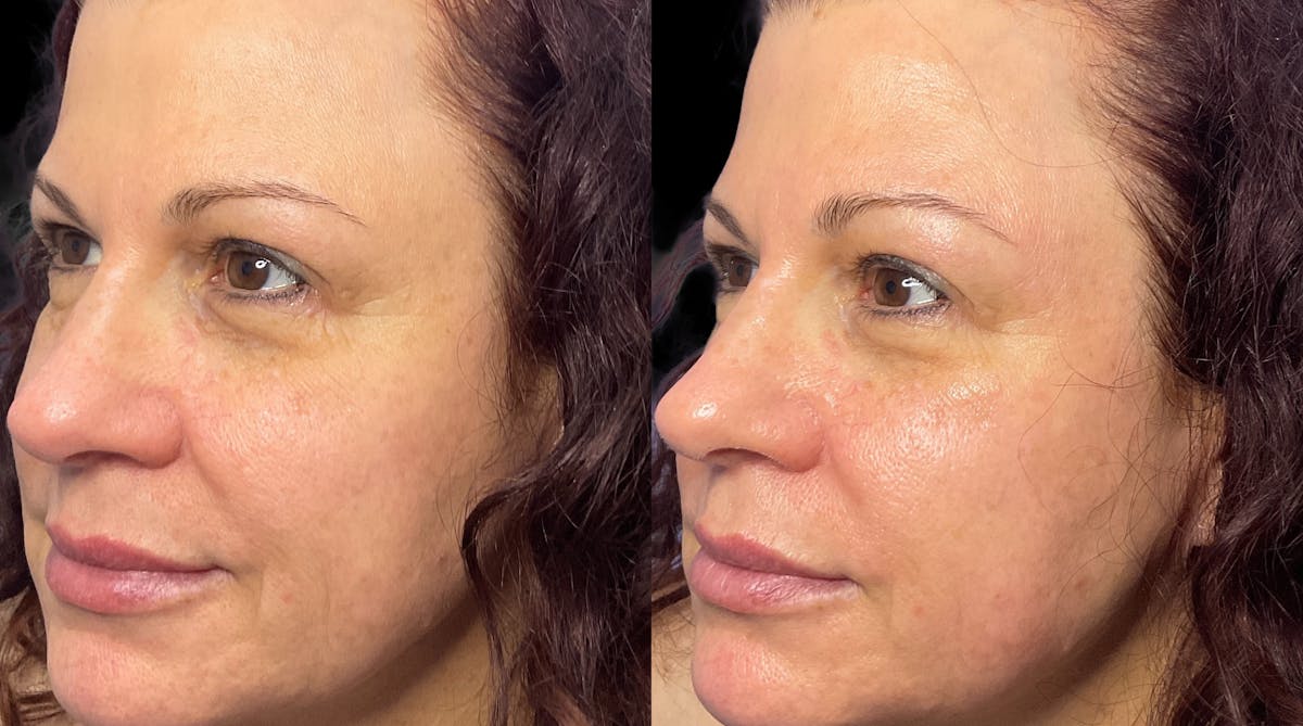 Medical Grade Facials Before & After Gallery - Patient 123129 - Image 2