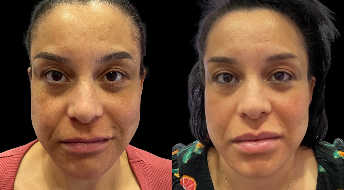 Hydrafacial Before & After Gallery - Patient 163350 - Image 1
