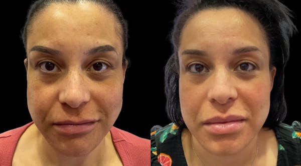 Hydrafacial Before & After Gallery - Patient 163350 - Image 1